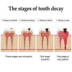 Tooth decay and root canals Bristol