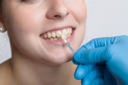 Dental veneers Bristol