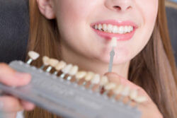 Dental Veneer Bristol