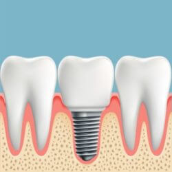 Dental Implants Specialists