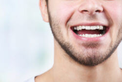 Teeth Whitening Cost Bristol