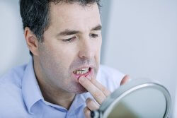 Can Teeth Whitening Damage Gums?