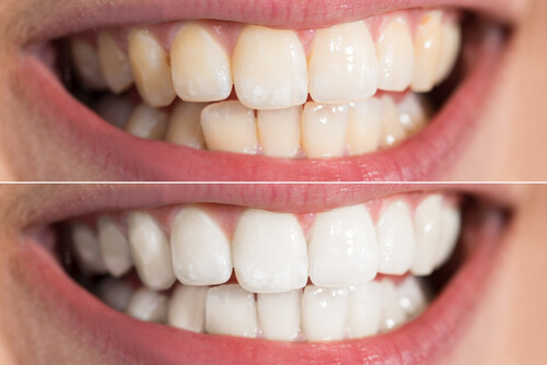 Can Teeth Whitening Damage Enamel