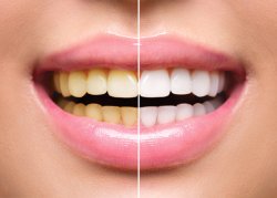 How Does Teeth Whitening Work?
