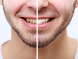 Will Teeth Whitening Remove Stains?