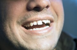Replacing Missing Teeth