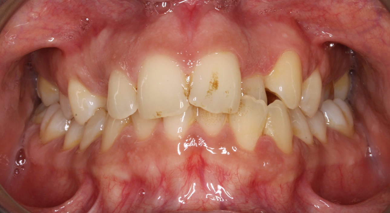 Lingual Braces