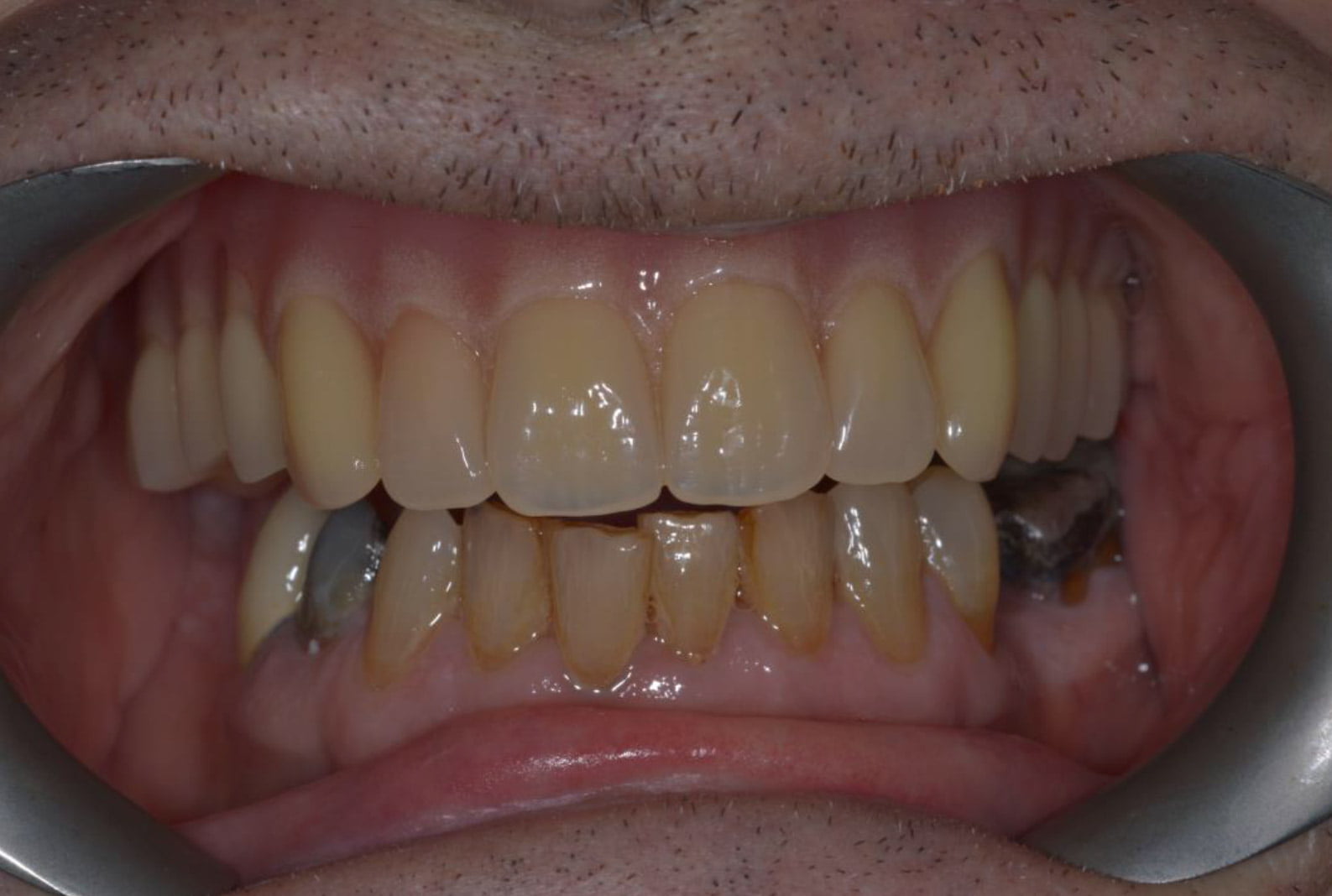 Implant Secured Dentures