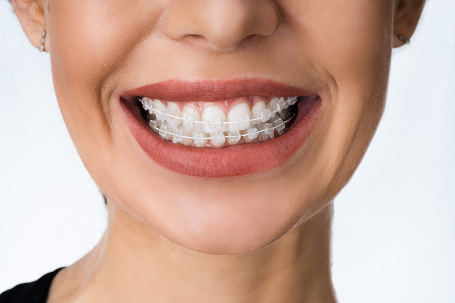 Six Month Smiles vs Invisalign: Which is Better?
