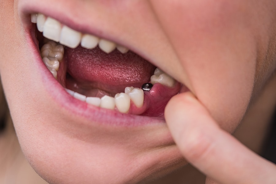 Are Dental Implants Like Natural Teeth?