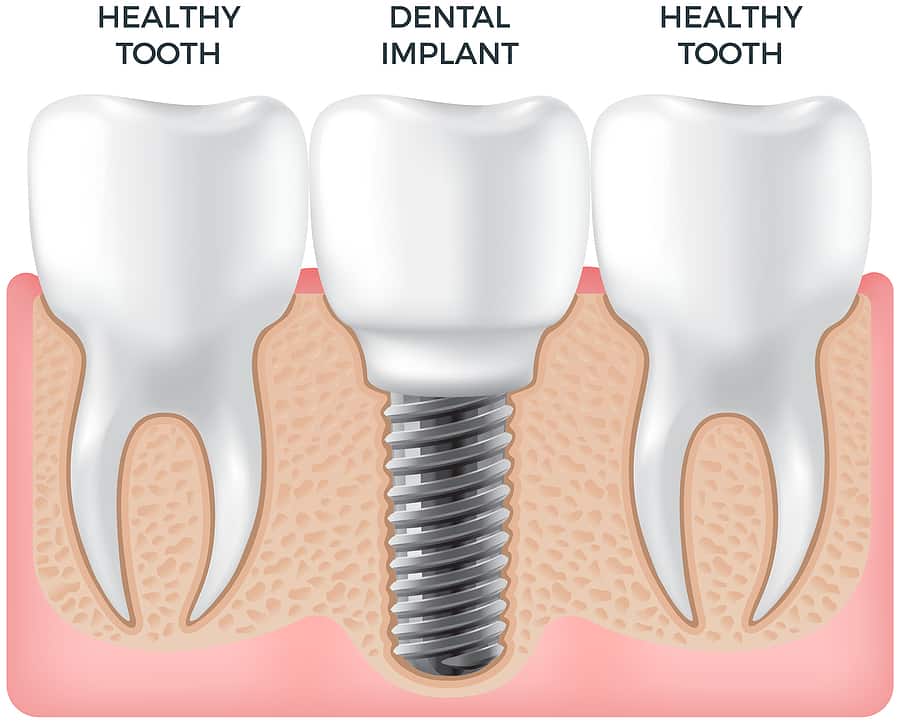 Are Dental Implants Like Natural Teeth?