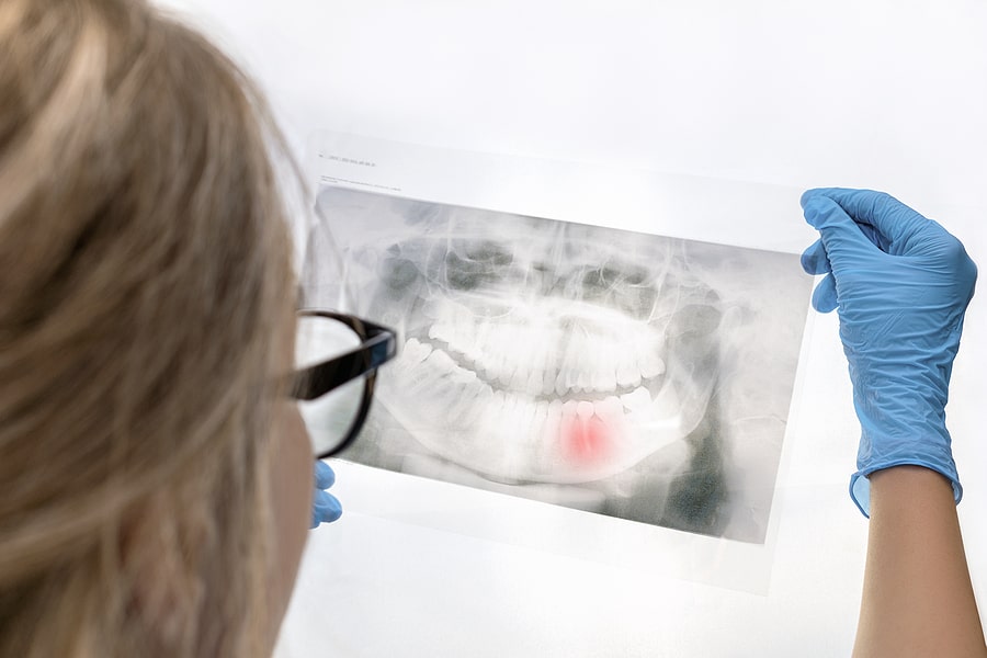 What Root Canal Treatment Involves?