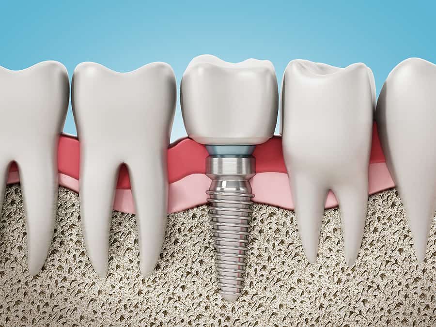 Are Dental Implants Permanent?&nbsp;
