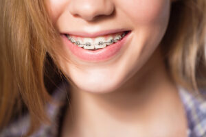 Invisalign or braces. Close up portrait of smiling teen girl showing dental braces.