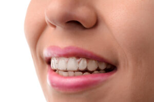 Invisalign or braces. Close up of young woman smiling with a clear aligner 