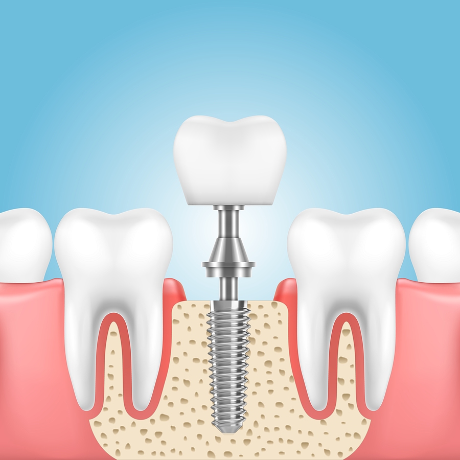 How a Dental Implant Can Change Your Smile