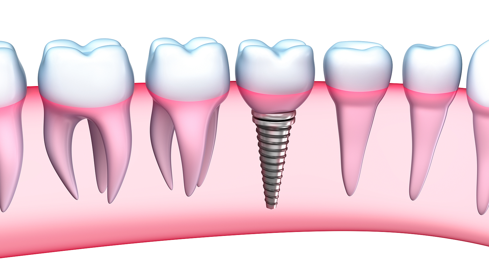 Why Start Your Dental Implant Journey Now