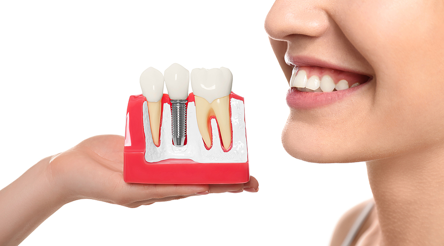 Why Start Your Dental Implant Journey Now