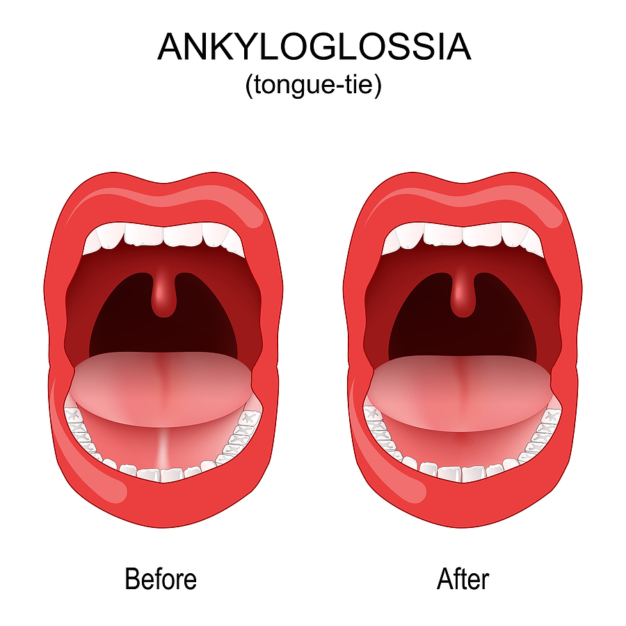 The Role of Frenectomy in Treating Tongue-Tie