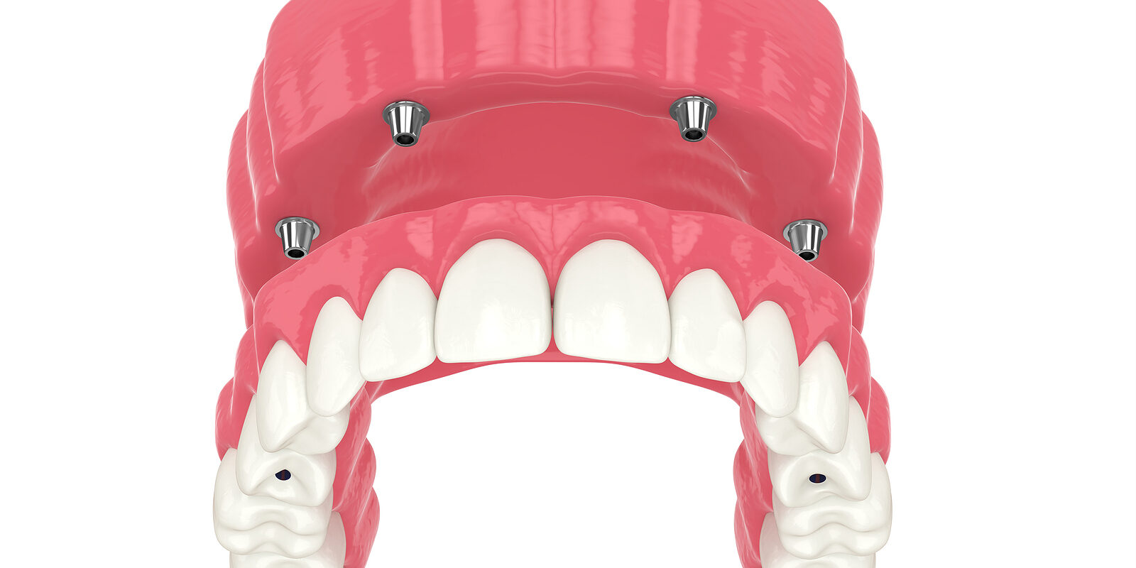 3D Render Of All On 4 Dental Implants Treatment