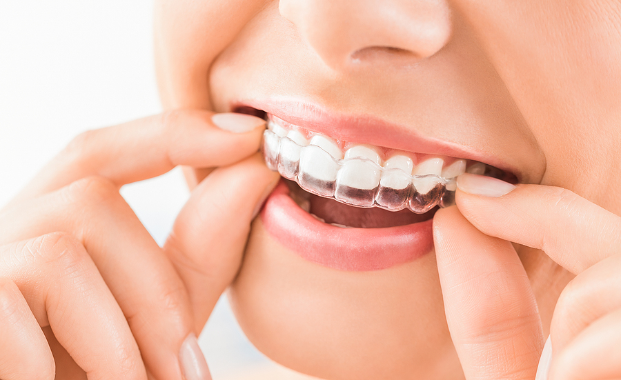 Invisalign: The Benefits and Why it&rsquo;s a Wise Investment