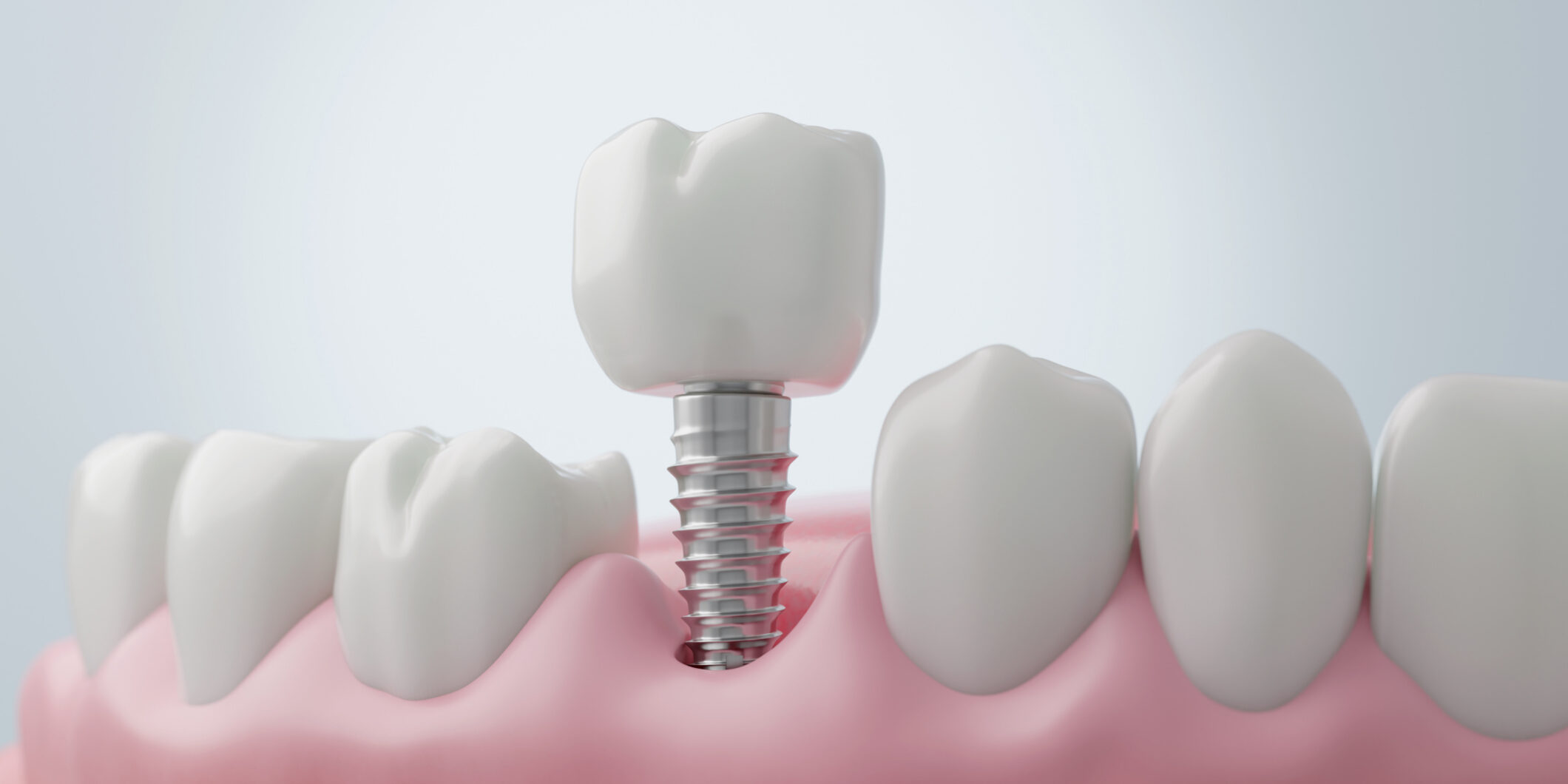 Titanium Dental Implant Surgery for Molar Tooth Replacement